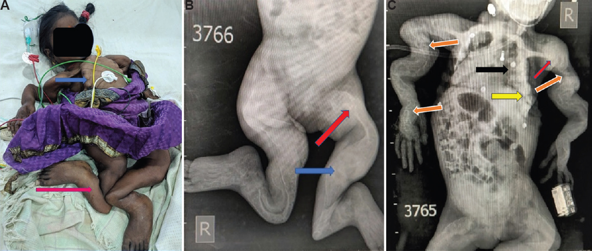 (A) Patient with deformed limbs (pink arrow), beaded ribs (blue arrow) and flail chest. (B) X-ray of the lower limbs showing reduced bone density, severe bony deformities with deformed gracile (blue arrow) and protrusion acetabuli with Coxa Vara. (C) X-ray of the upper body showing severe kyphoscoliosis (black arrow), multiple fractures (orange arrows), pectus excavatum with broad ribs (yellow arrow) and multiple healing fractures (red arrows).